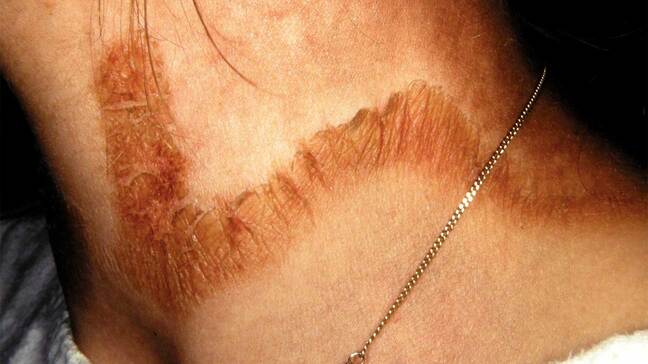 Brown, scaly, collar-shaped band of darkened skin encircling the base of the neck, known as Casal’s necklace