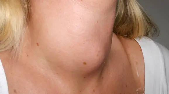 Front of a neck showing a smooth swelling below the Adam’s apple from an enlarged thyroid gland
