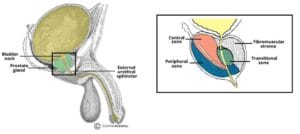 Anatomical diagram showing the location of the prostate gland below the bladder, with an inset of its zones